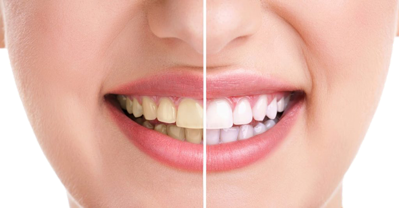 Gum bleaching in Smiles by Dr. Mario Montoya
